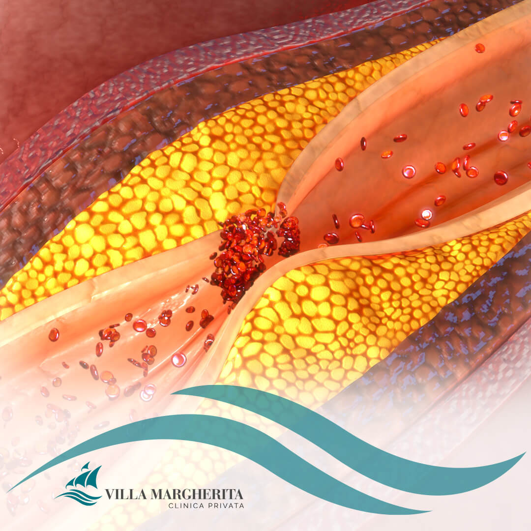 Coronarografia cardiaca